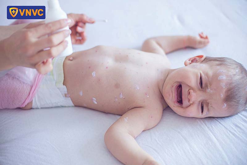 vệ sinh cơ thể cho bé bị thủy đậu