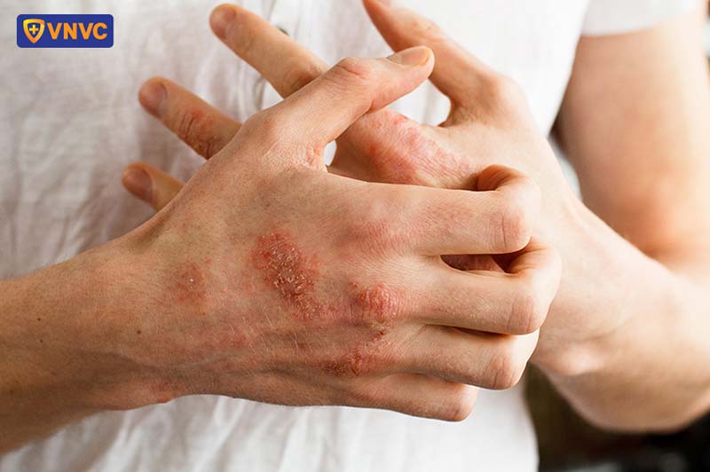 viêm da tiếp xúc