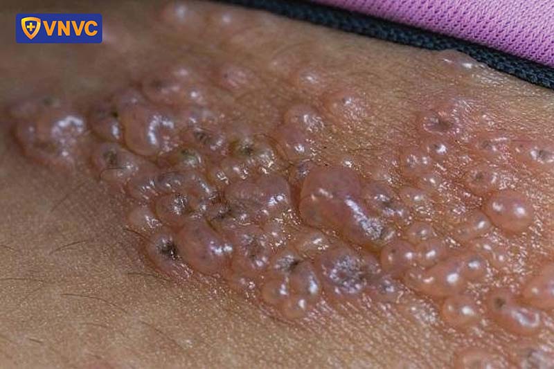 zona bị bội nhiễm