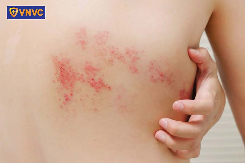 zona thần kinh bội nhiễm