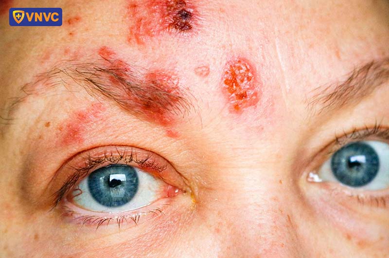 bệnh zona ở mặt