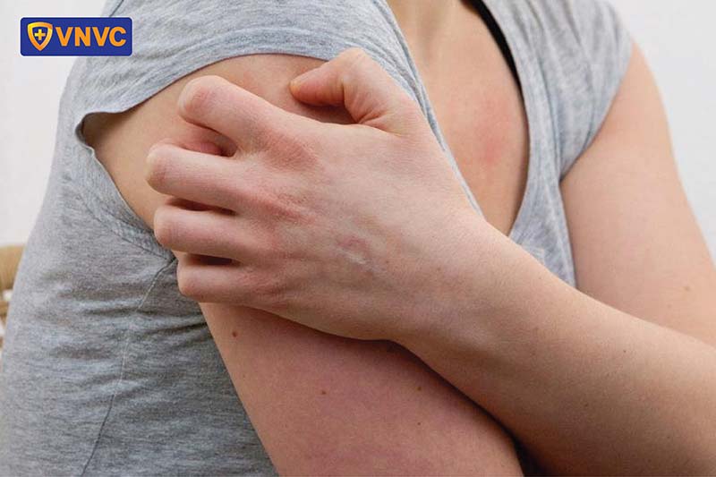 bị ngứa khi bị thủy đậu