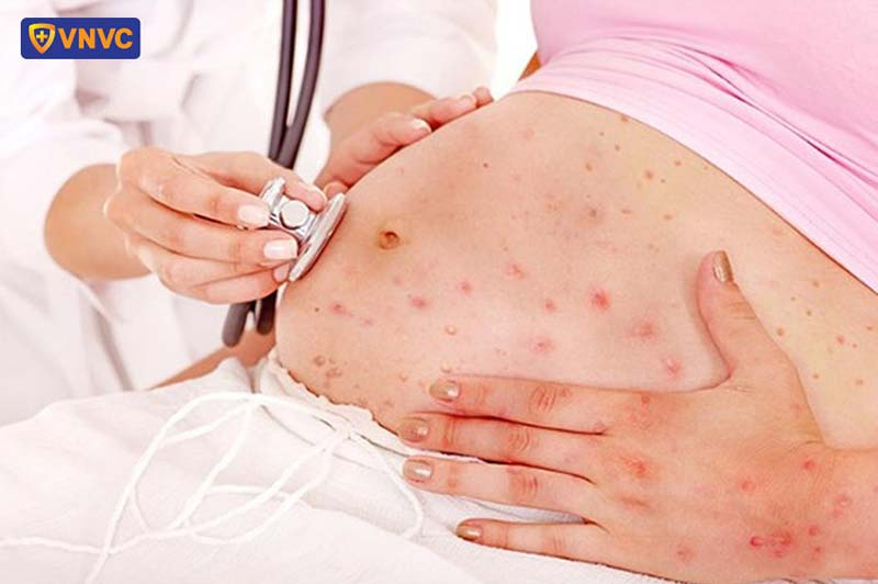 bị phỏng dạ khi mang thai