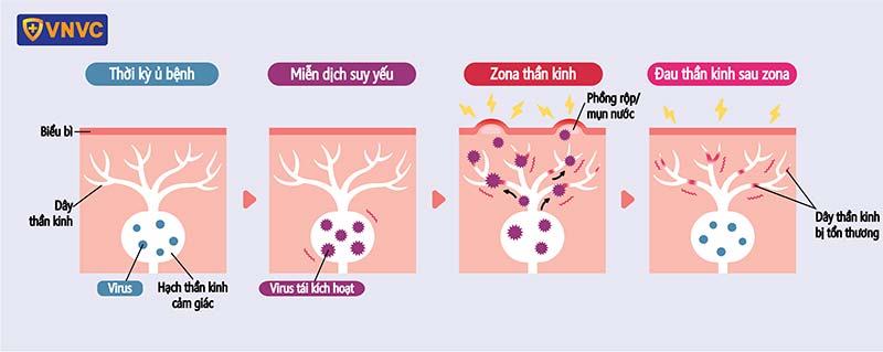 biến chứng đau dây thần kinh sau zona