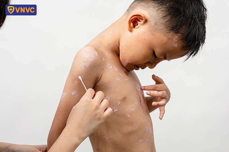 bôi thuốc lên mụn thủy đậu