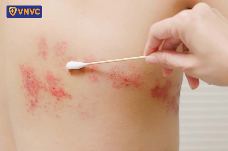 cách chữa zona tại nhà