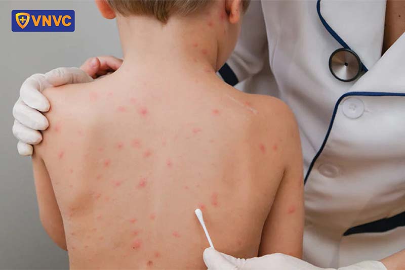 chăm sóc da cho bé bị thủy đậu