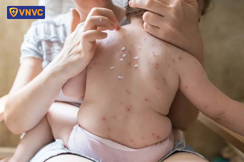 chăm sóc da cho bé bị thủy đậu