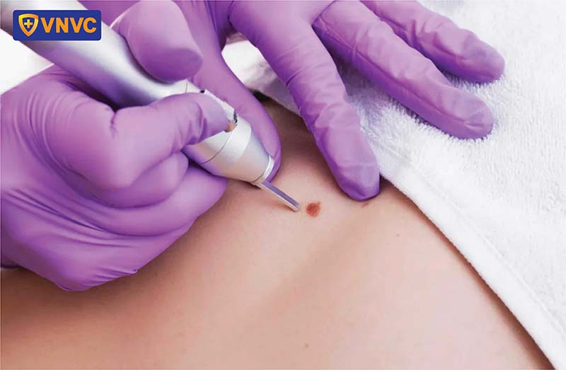 điều trị mụn cóc sinh dục