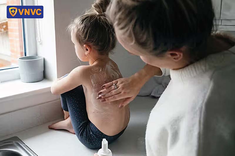 dưỡng da cho bé sau khi bị thủy đậu