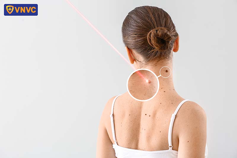hình ảnh mụn cóc sinh dục nữ