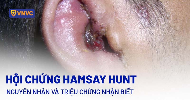 hội chứng ramsay hunt