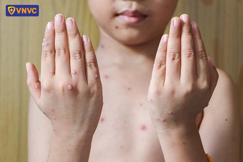 mụn thủy đậu nổi trên người trẻ em