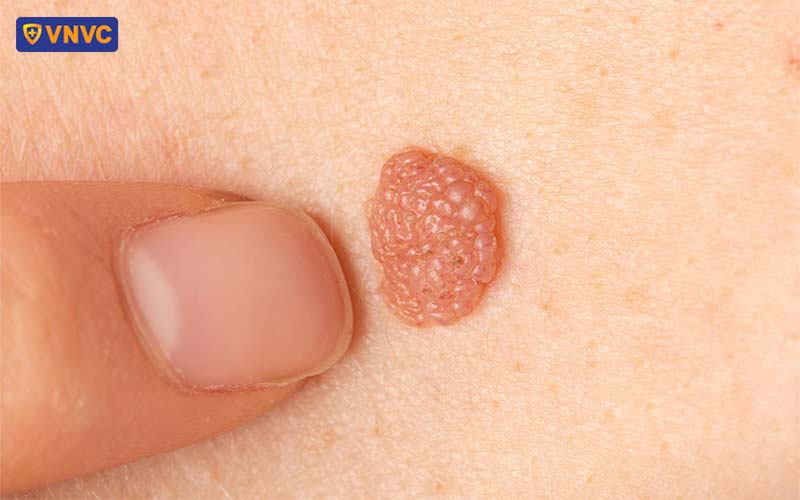 nốt mụn cóc sinh dục ở nữ