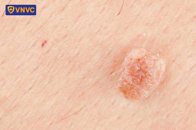 nốt mụn cóc sinh dục