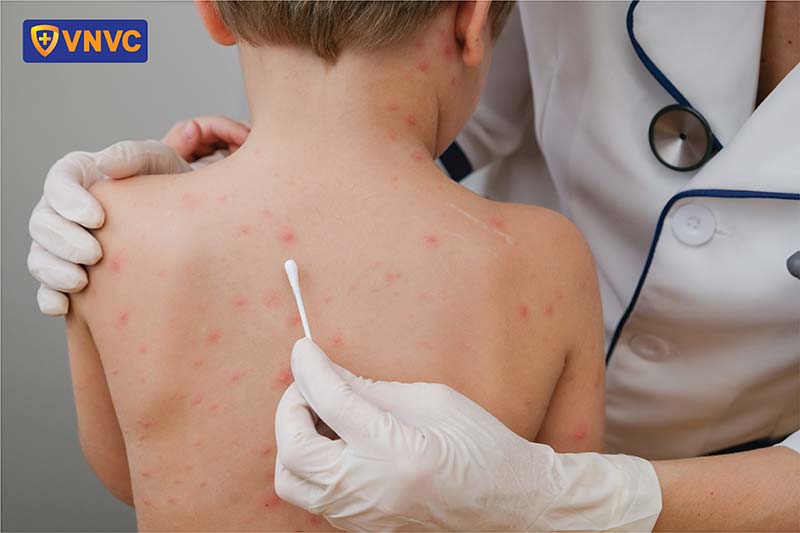 thoa thuốc cho trẻ em bị thủy đậu