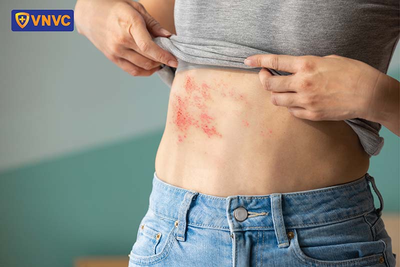 zona thần kinh gây ra bởi virus VZV