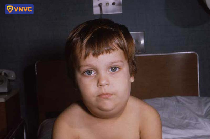 bé trai mắc quai bị