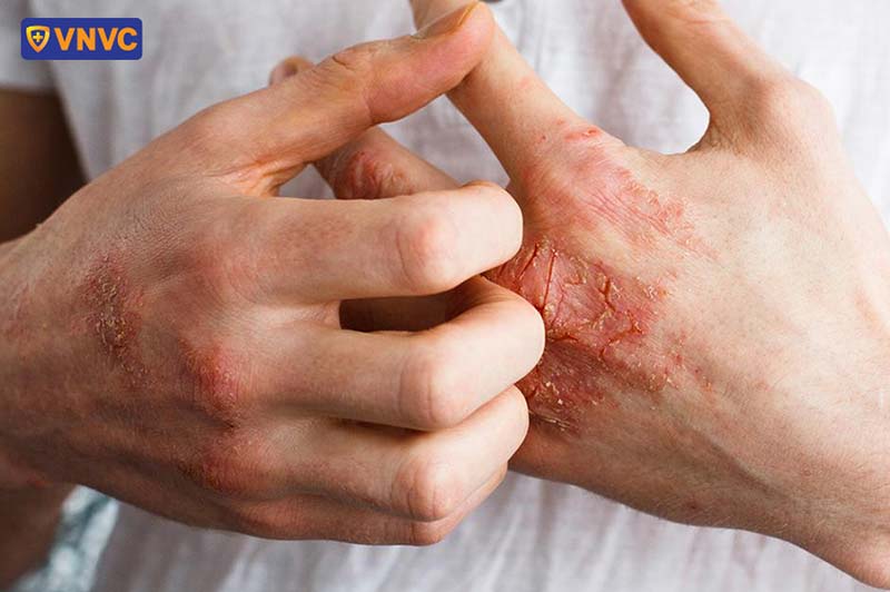 bệnh zona thần kinh ở tay