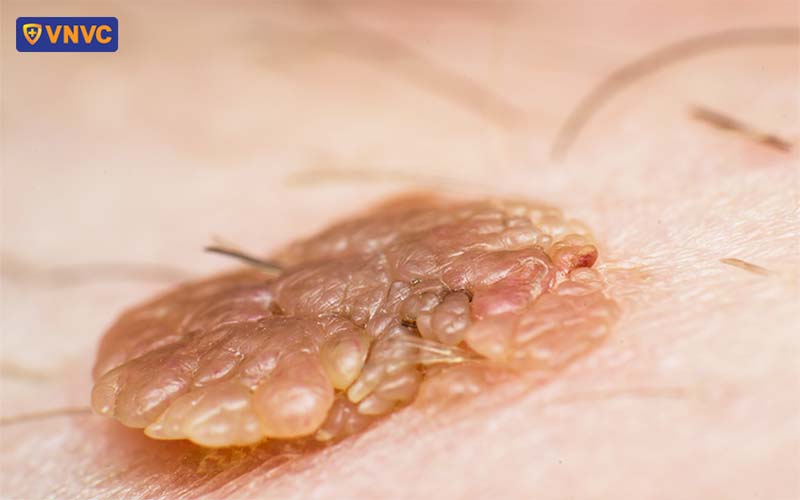 nốt sùi mào gà gây ngứa khó chịu
