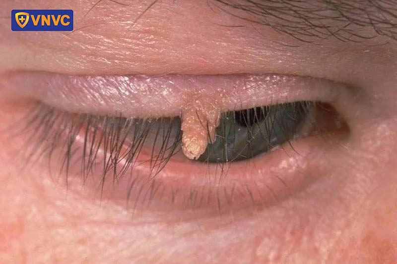 sùi mào gà mọc ở mí mắt