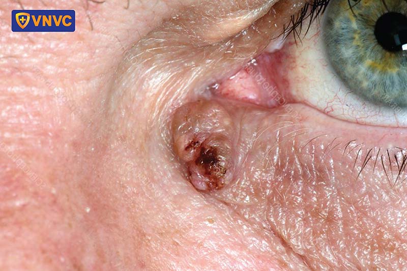 sùi mào gà nổi ở khéo mắt