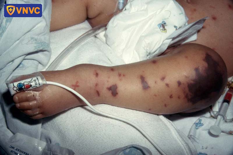 biến chứng do viêm não mô cầu nhóm b