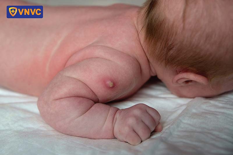 hình ảnh tác dụng phụ sau tiêm vắc xin