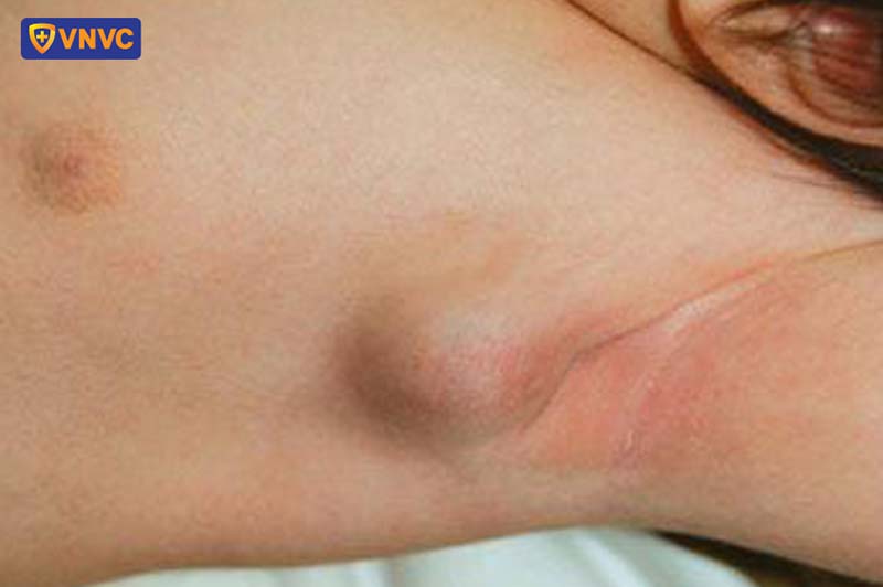 hình ảnh tác dụng phụ sau tiêm vắc xin