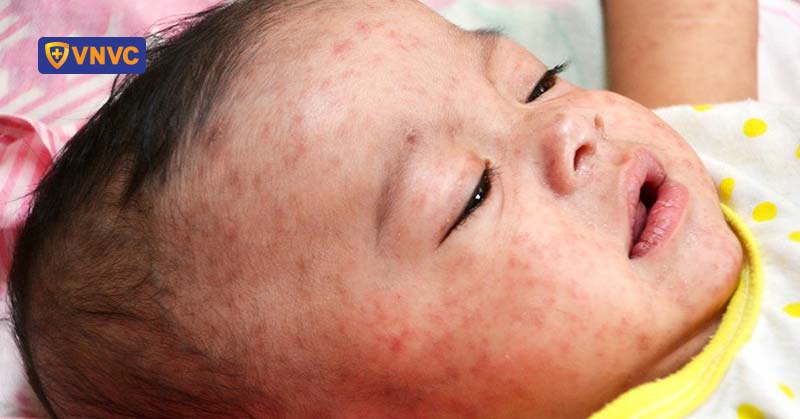 nguy cơ bùng phát dịch sởi sau tết