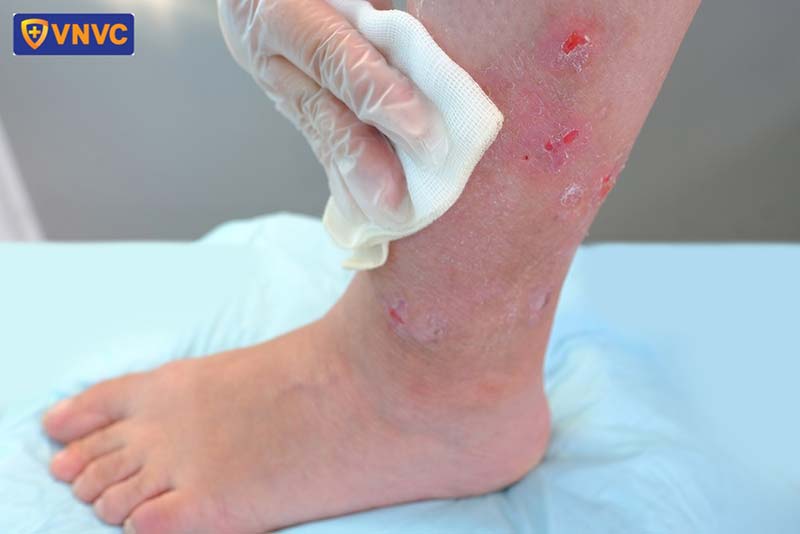 nguy cơ mắc bệnh dại khi bị chó cắn