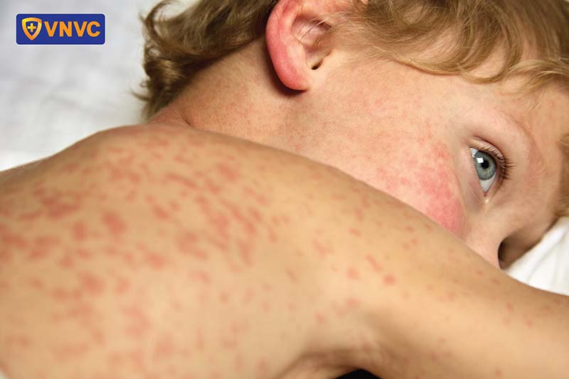 trẻ mắc bệnh sởi