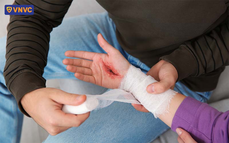 xử lý vết thương sau khi bị chó cắn