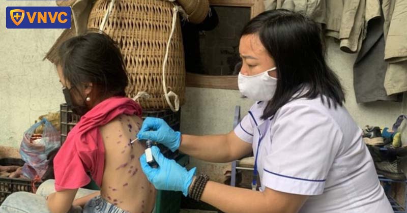 bác sĩ bôi thuốc thủy đậu cho bé