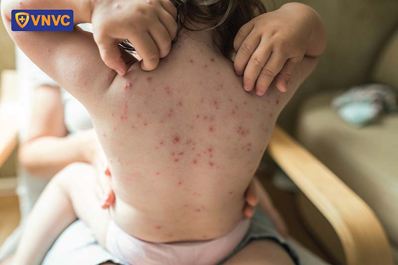 bệnh giời leo ở trẻ em