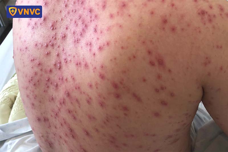 bệnh thủy đậu biến chứng