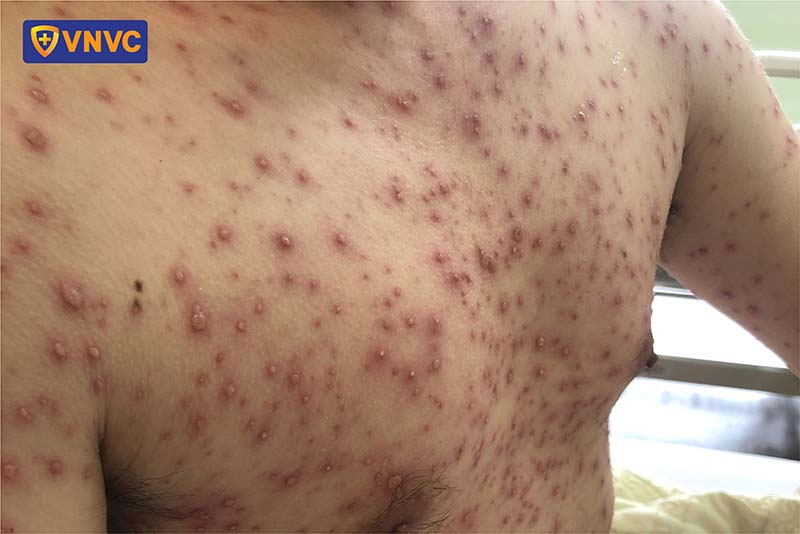 biến chứng thủy đậu ở người lớn