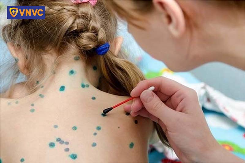 bôi thuốc cho bé bị thủy đậu