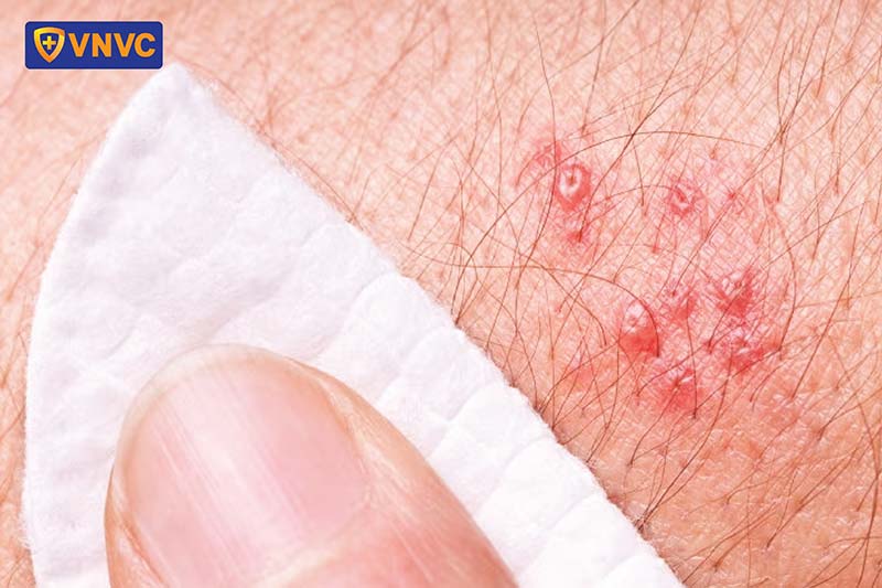 điều trị giời leo