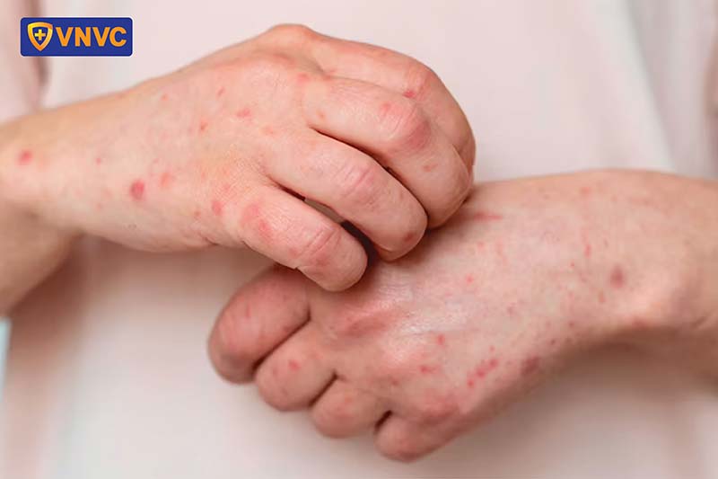 giời leo ở trẻ em