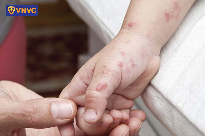 giời leo ở trẻ nhỏ