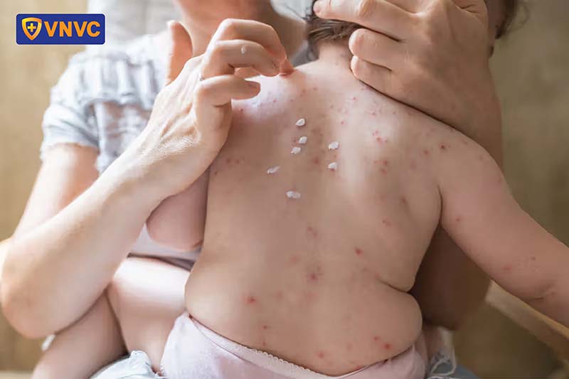 trị giời leo cho trẻ