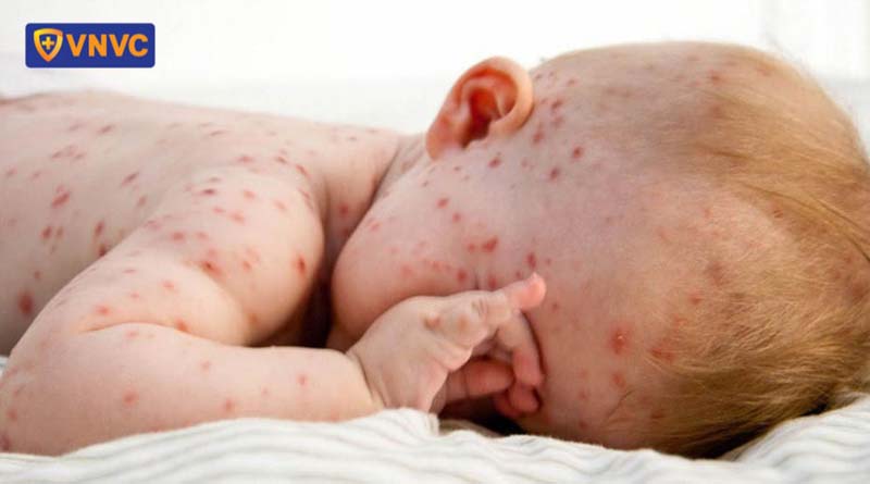 bệnh sởi ở trẻ em