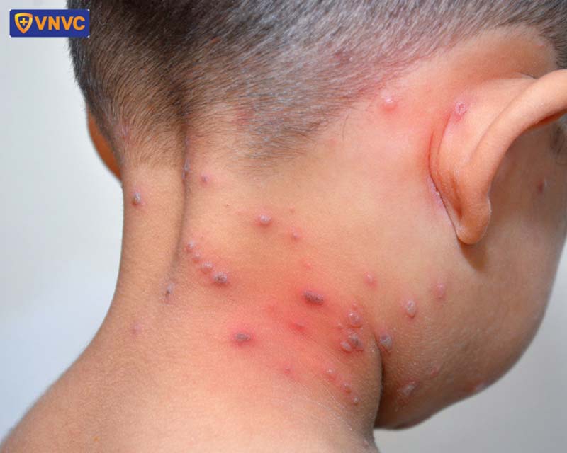 bệnh thủy đậu ở trẻ em