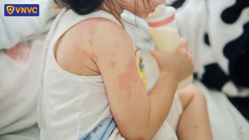 trẻ bị phát ban do sởi
