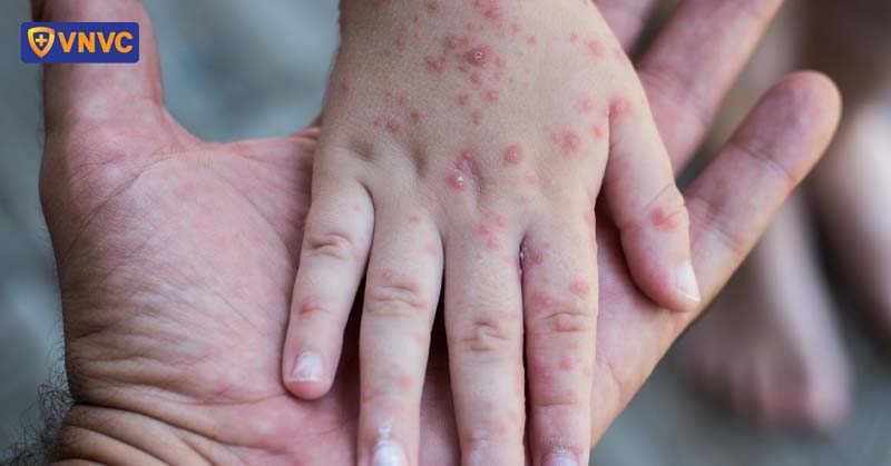 trẻ em mắc bệnh sởi