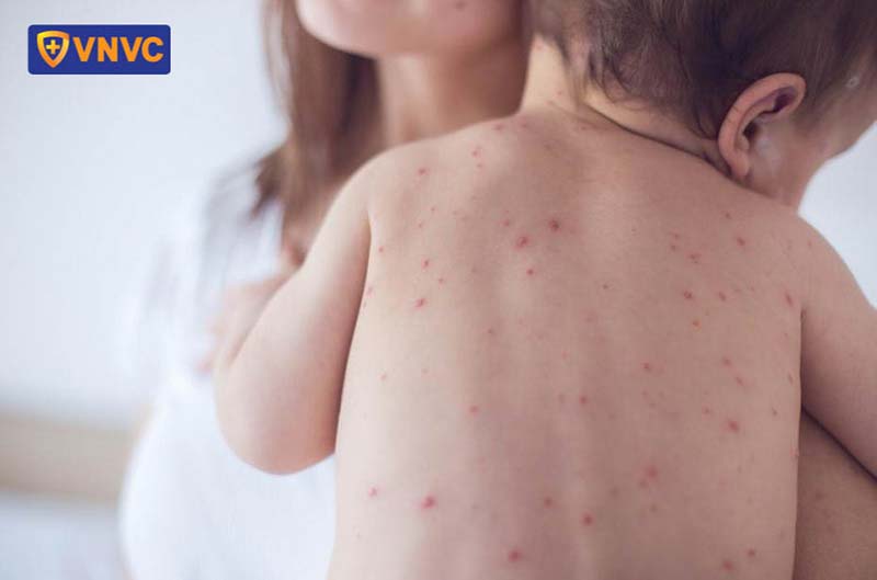 trẻ mắc bệnh sởi