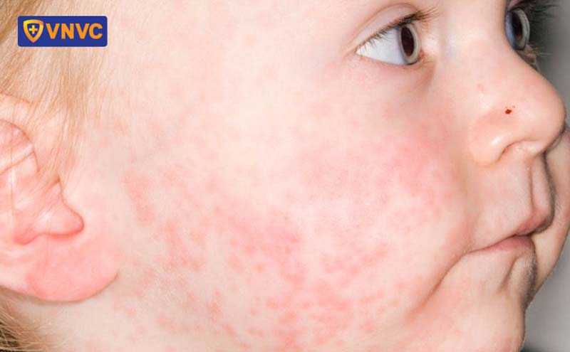 trẻ nhỏ mắc bệnh sởi