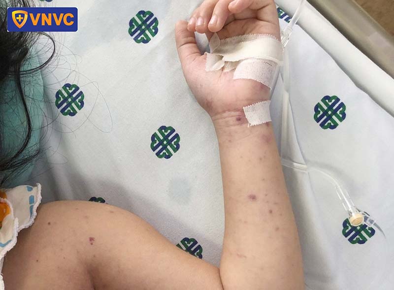 triệu chứng viêm màng não mô cầu nhóm b