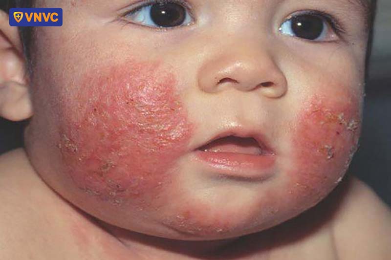 bé bị viêm da có tiêm phòng được không